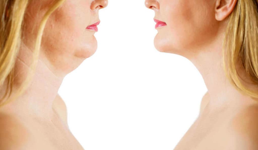 Double Chin treatment Moss Side before and after results
