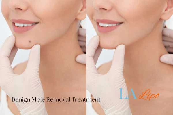 woman's before and after mole removal Moss Side results
