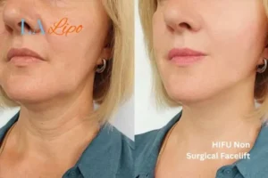 hi-fu for wrinkles Moss Side before and after results