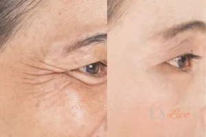 Before and after results of woman - HI-fu wrinkles reduction treatment Moss Side