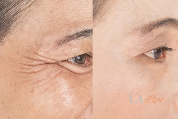 Before and after results of woman - HI-fu wrinkles reduction treatment Moss Side