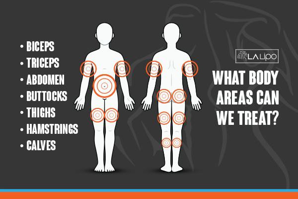 Graphic to show areas you can have LA-EMS Body Sculpting Moss Side treatment.
