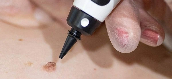 skin tag removal using cryopen Moss Side