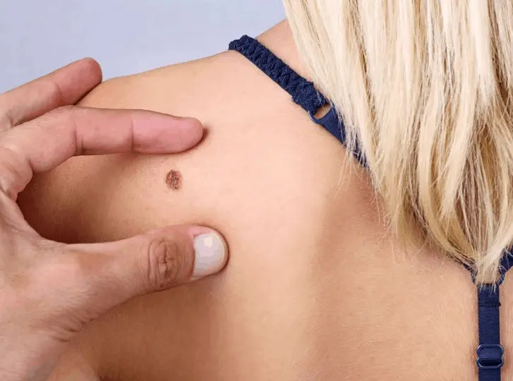woman having mole removal Moss Side consultation before treatment.