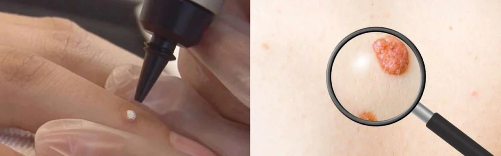 CryoPen practitioner Moss Side assessing a benign mole before treatment
