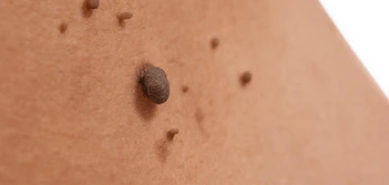 image of a skin tag Moss Side