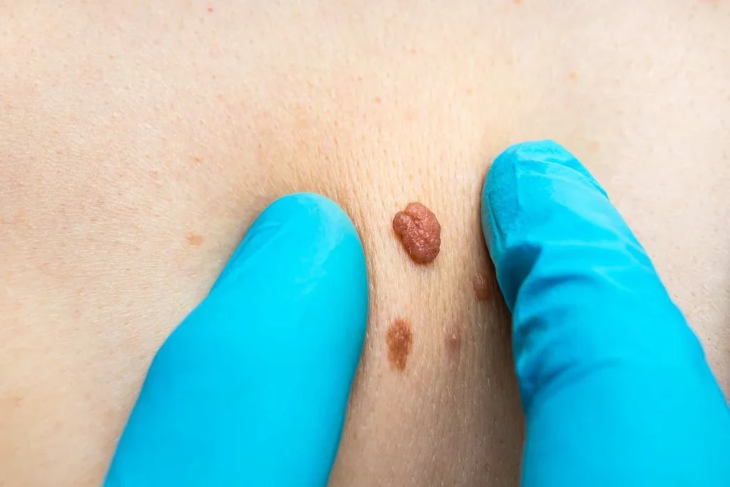 Consultant examining a skin tag Moss Side