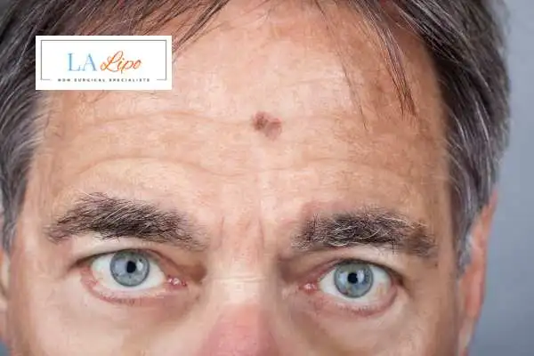 Solar Lentigo Removal Moss Side image of man with mark on his forehead