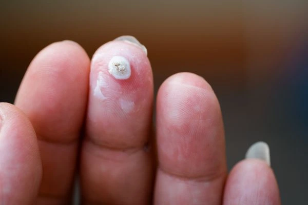 wart on person finger - cryotherapy to treat from LA LIPO Moss Side