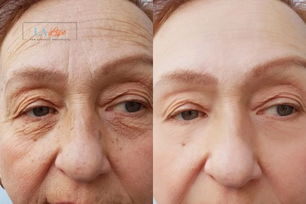 The powerful benefits of Morpheus8 Treatment Moss Side - Call Our team today!