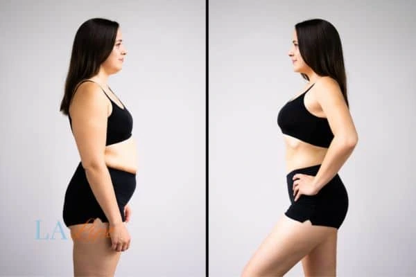 Picture of womans before and after using LA-EMS body sculpting to improve her core strength Moss Side