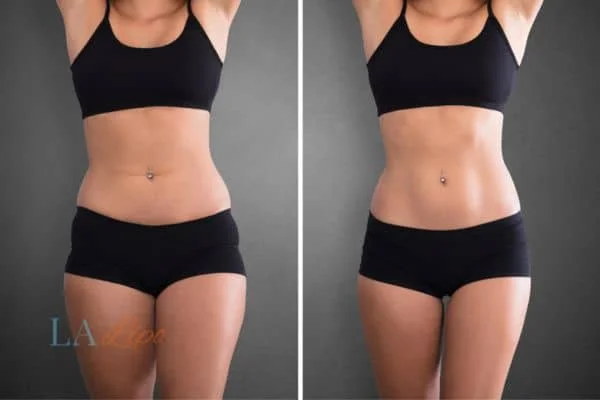 before and after results of non-surgical treatment to help a woman's body image and mental health Moss Side