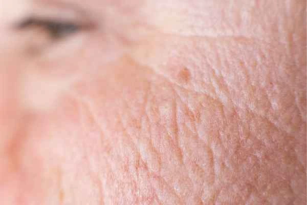 close up picture of a woman's face showing an age spot Moss Side