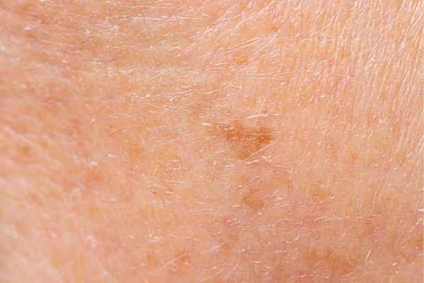 close up picture of age spots Moss Side