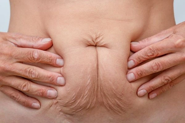Should I Combine Diastasis Recti Treatment with Body Contouring for Better Results Moss Side?