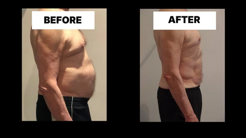 What Symptoms Can Diastasis Recti Cause in Men? Weak Core, Back Pain and Poor Posture Moss Side